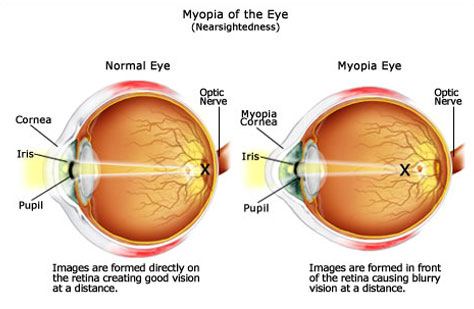 myopia oka pislog a szemben, de a látás normális